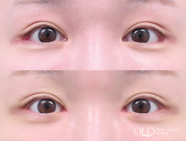 Before