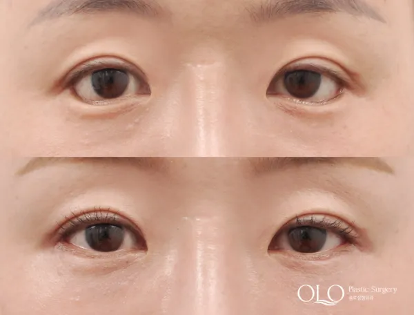 Before/After