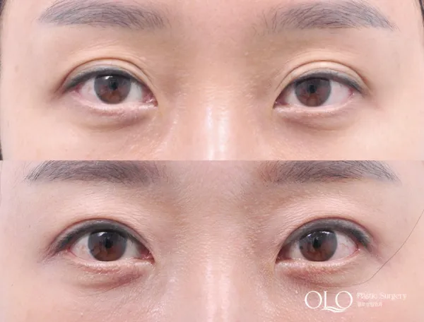 Before/After