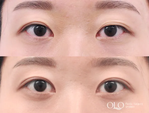 Before/After