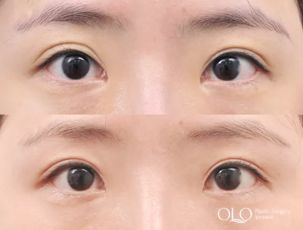 Before/After