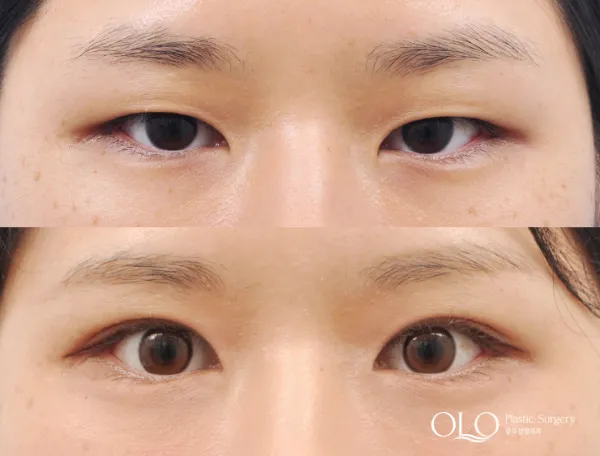 Before/After