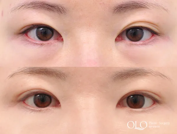 Before/After