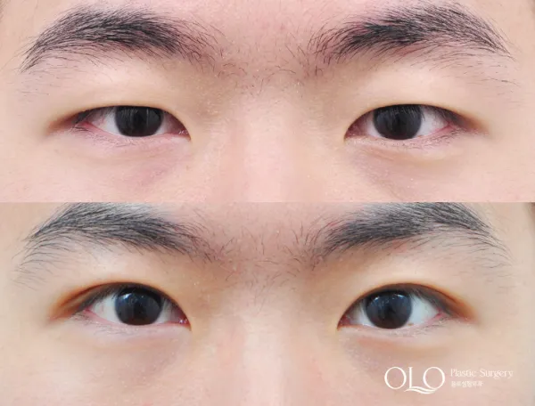 Before/After