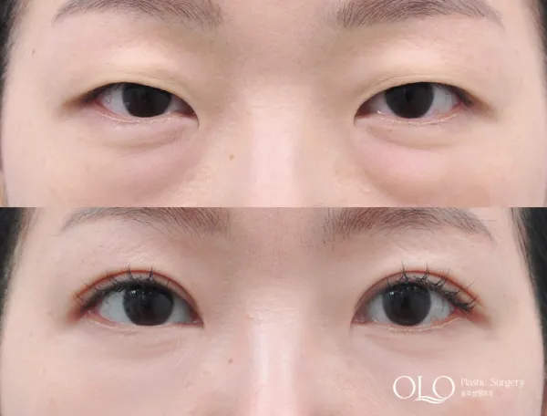Before/After