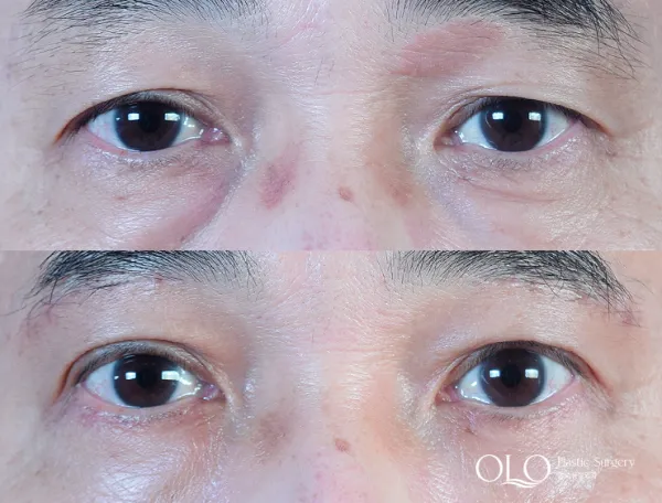 Before/After