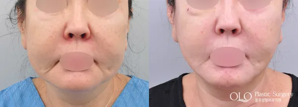 Before/After