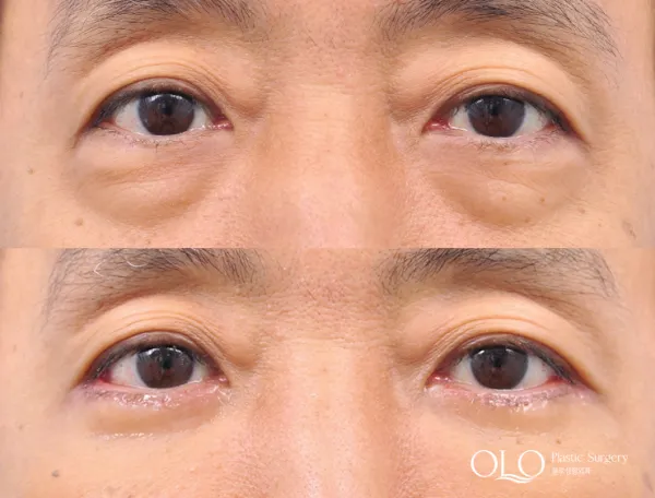 Before/After