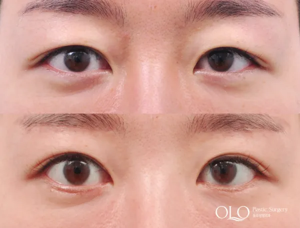 Before/After