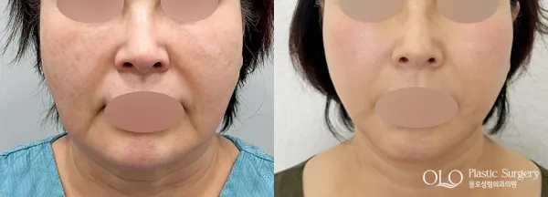 Before/After