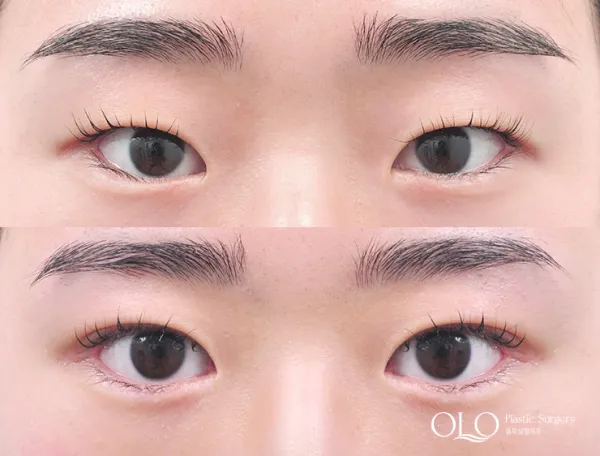 Before/After