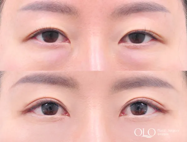 Before/After
