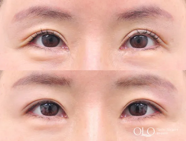 Before/After