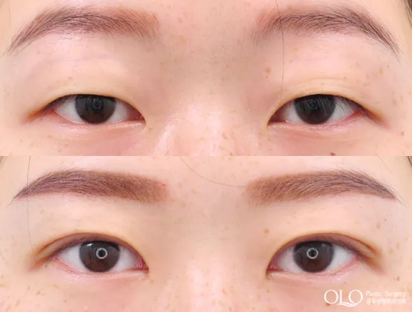 Before/After