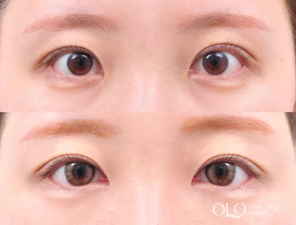 Before/After