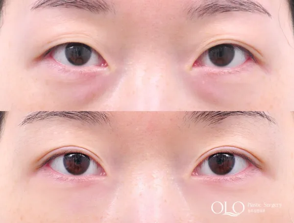 Before/After