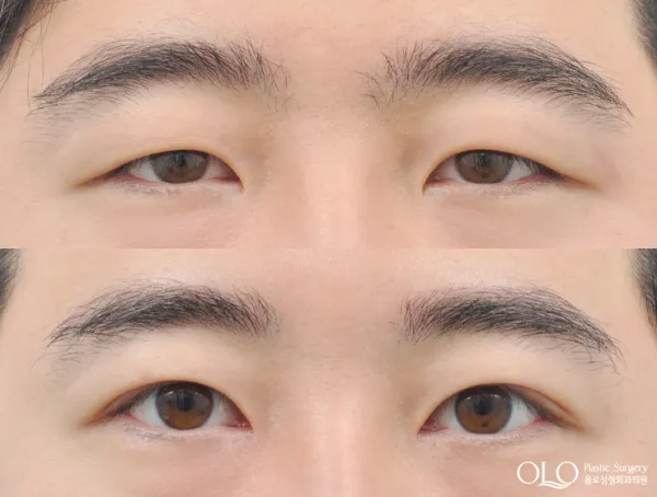 Before