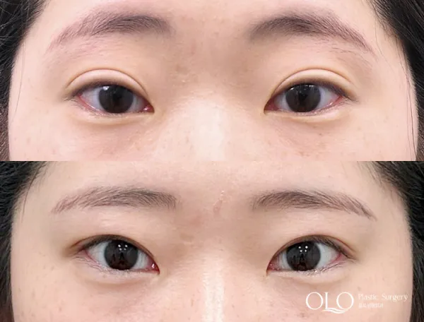 Before