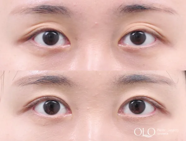 Before/After