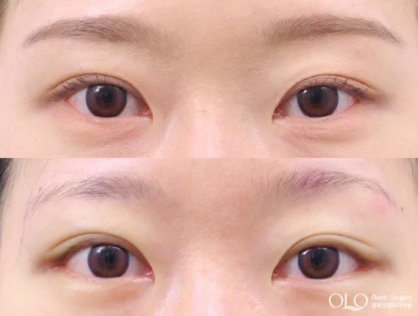 Before/After