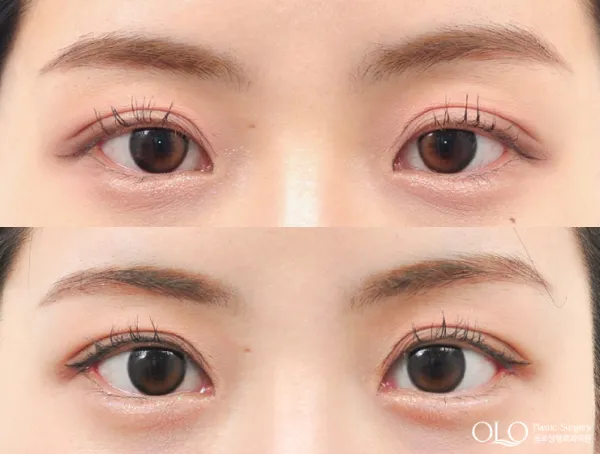 Before/After