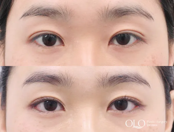 Before/After