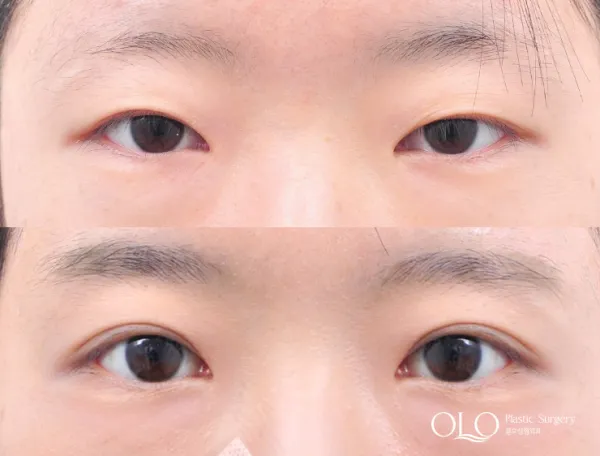 Before/After