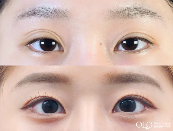 Before/After