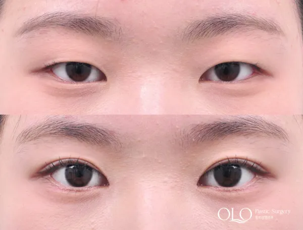 Before/After