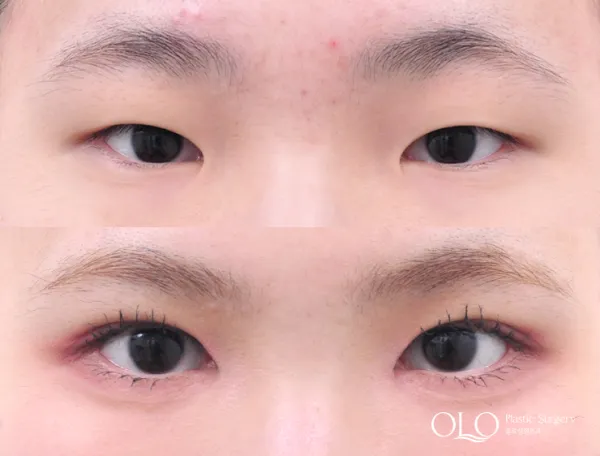 Before/After