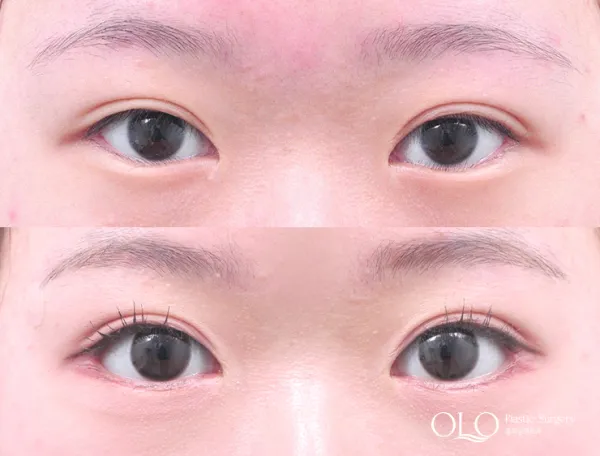 Before/After