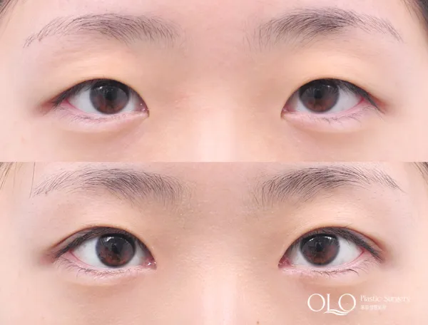 Before/After