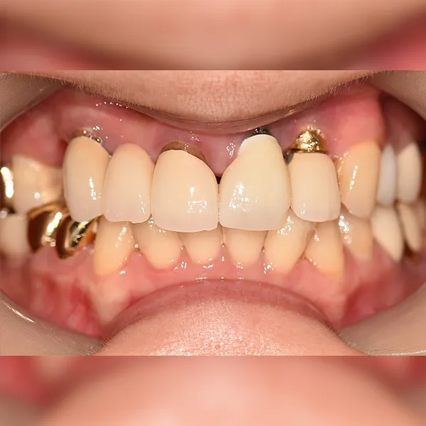 Before