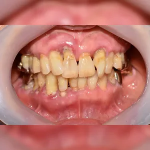Before