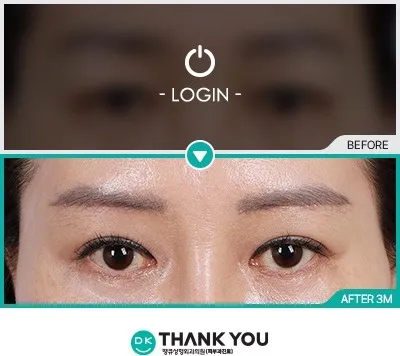 Before/After