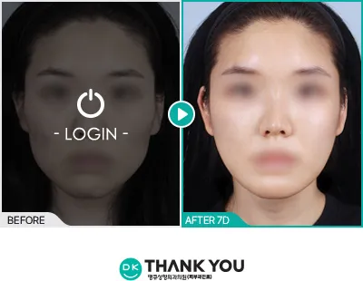 Before/After