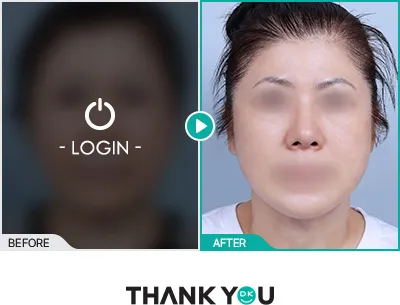 Before/After