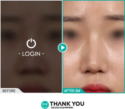 Before/After