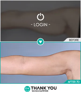 Before/After