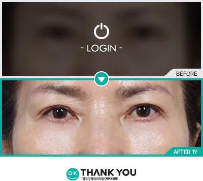 Before/After