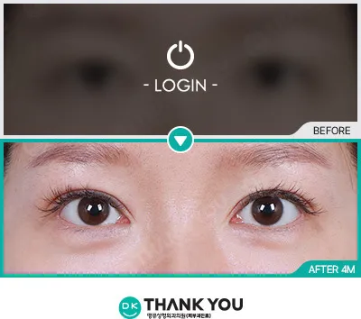 Before/After