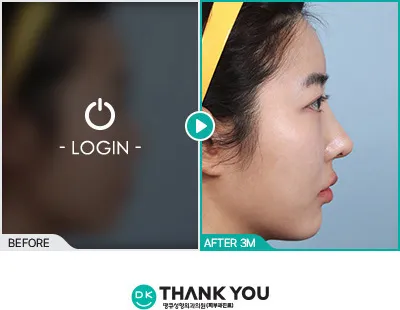 Before/After
