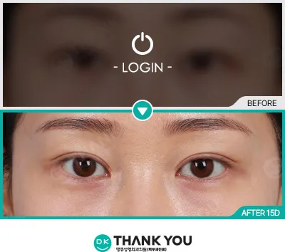 Before/After