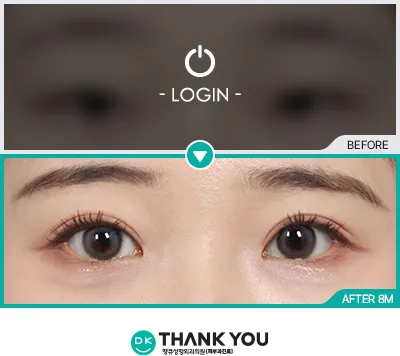 Before/After