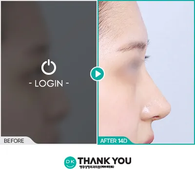 Before/After