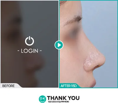 Before/After