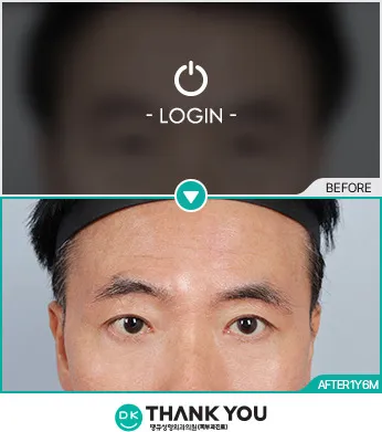 Before/After