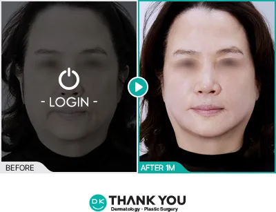 Before/After