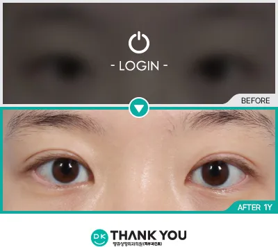 Before/After