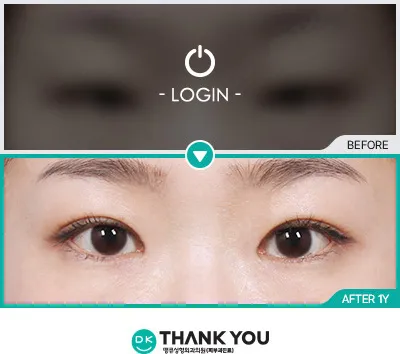 Before/After